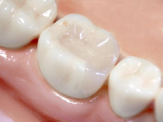 キレイだけじゃない！セラミックの歯のメリットって？